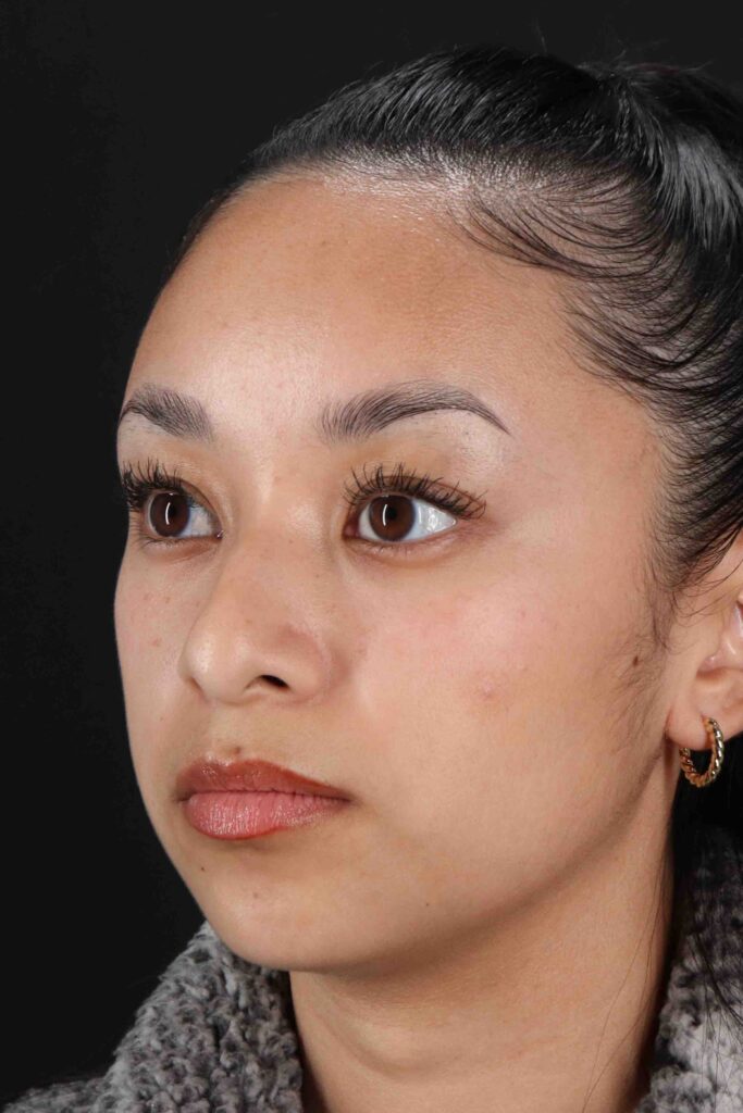 Before - left_oblique