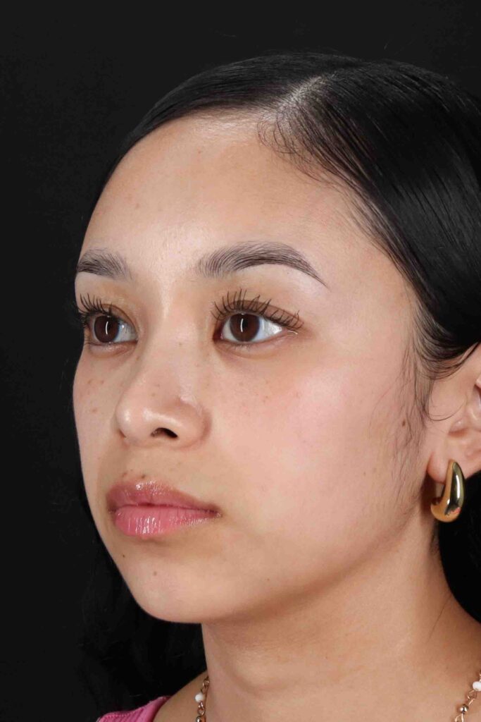 After - left_oblique