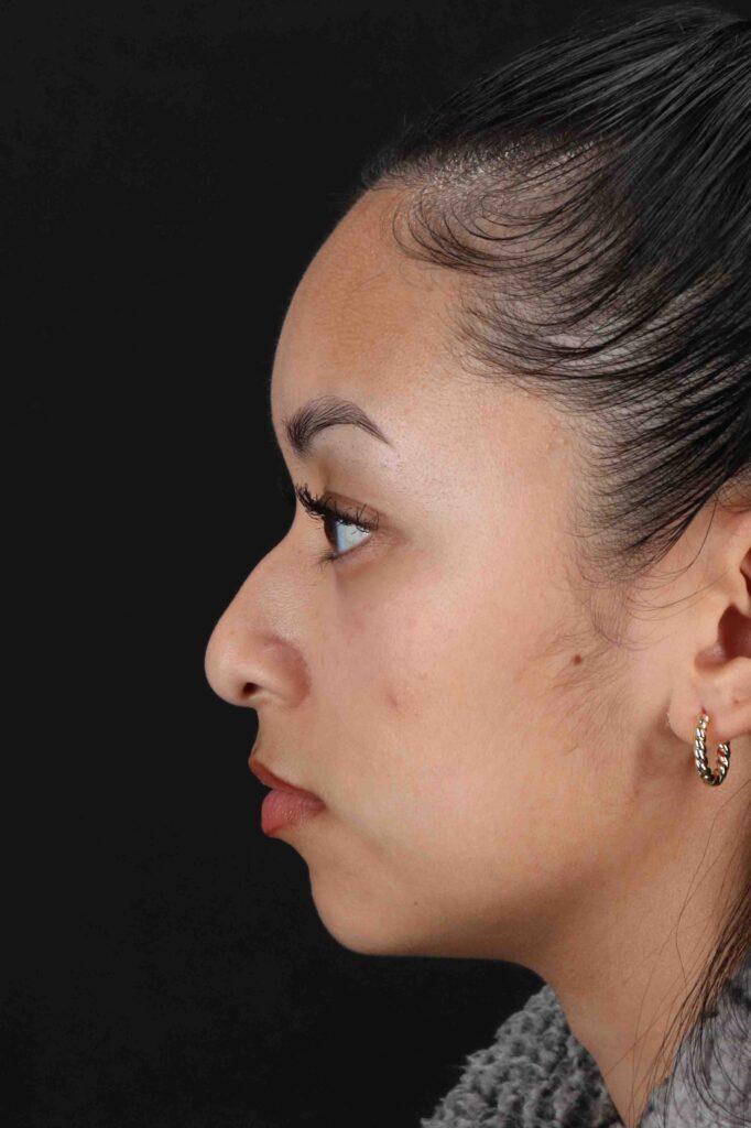 Before - left_lateral