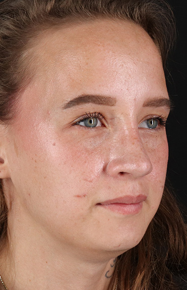 After - right_oblique