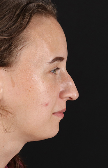 Before - right_lateral