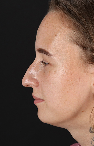 Before - left_lateral