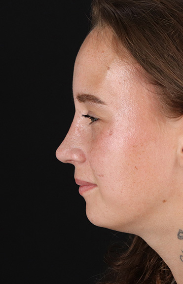 After - left_lateral