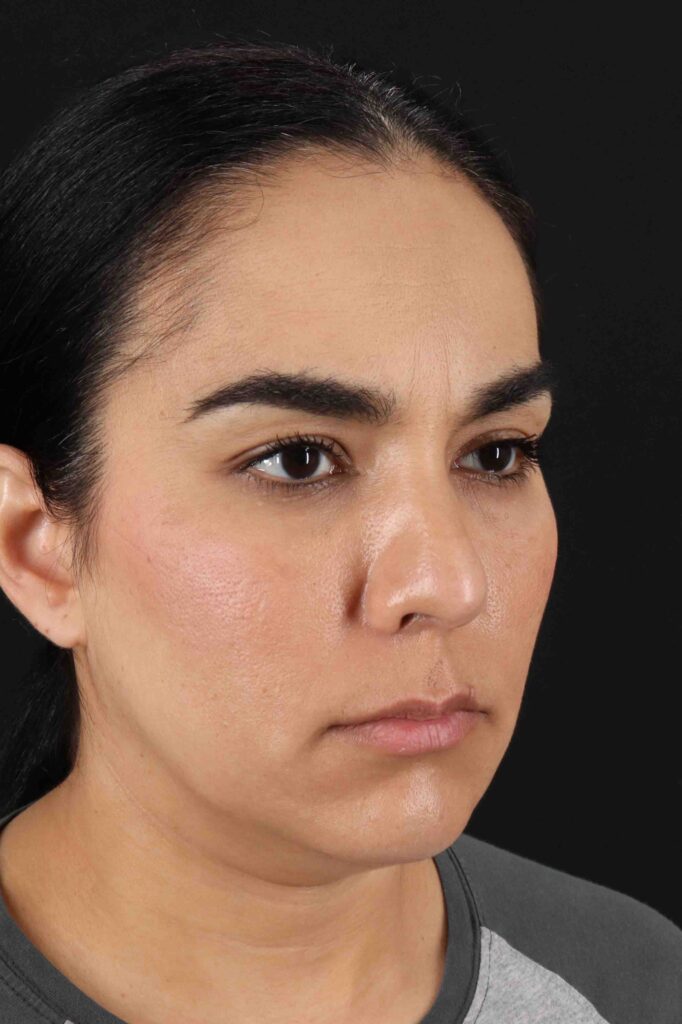 Before - right_oblique