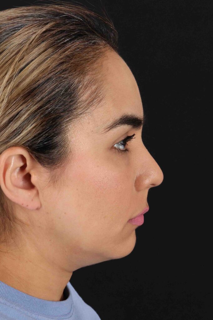 After - right_lateral