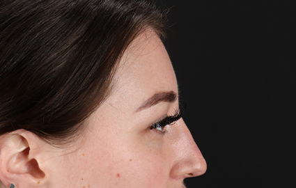 Before - right_lateral