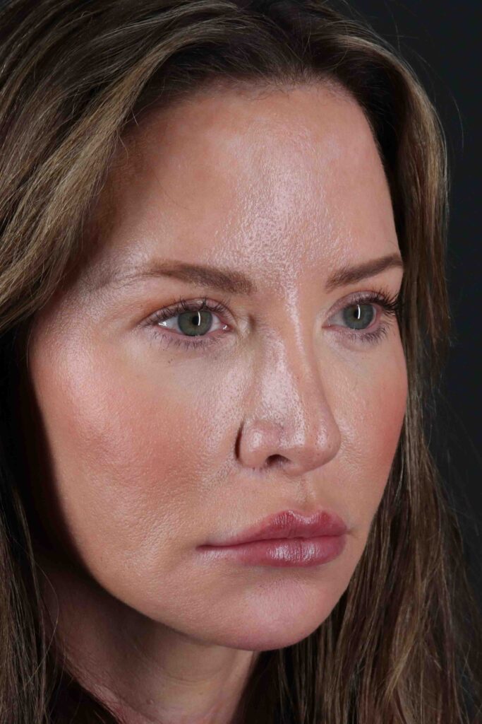 Before - right_oblique