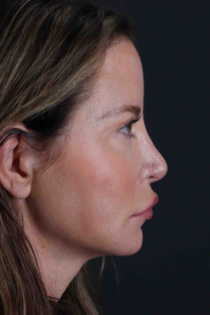 Before - right_lateral