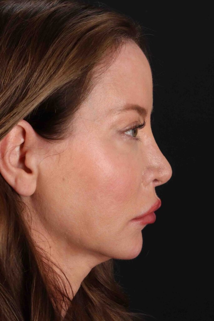 After - right_lateral