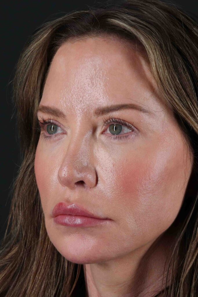 Before - left_oblique