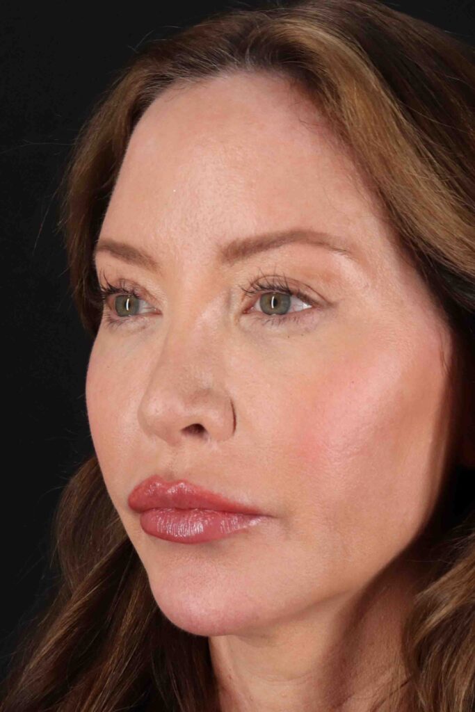 After - left_oblique