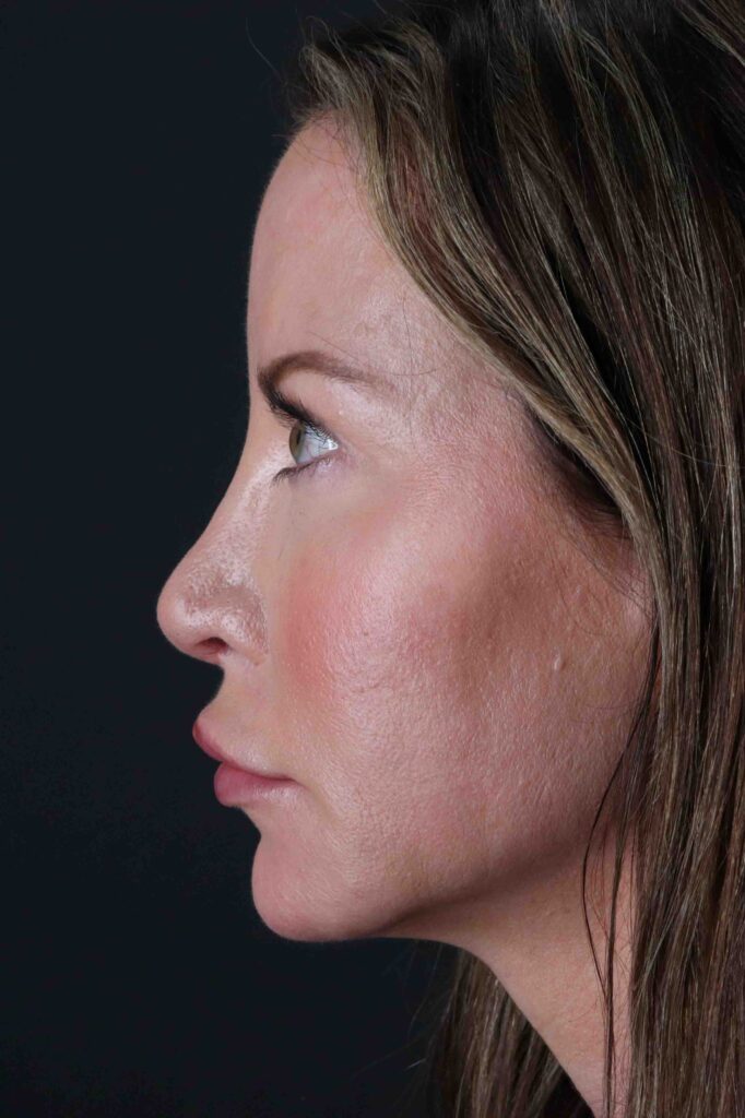 Before - left_lateral