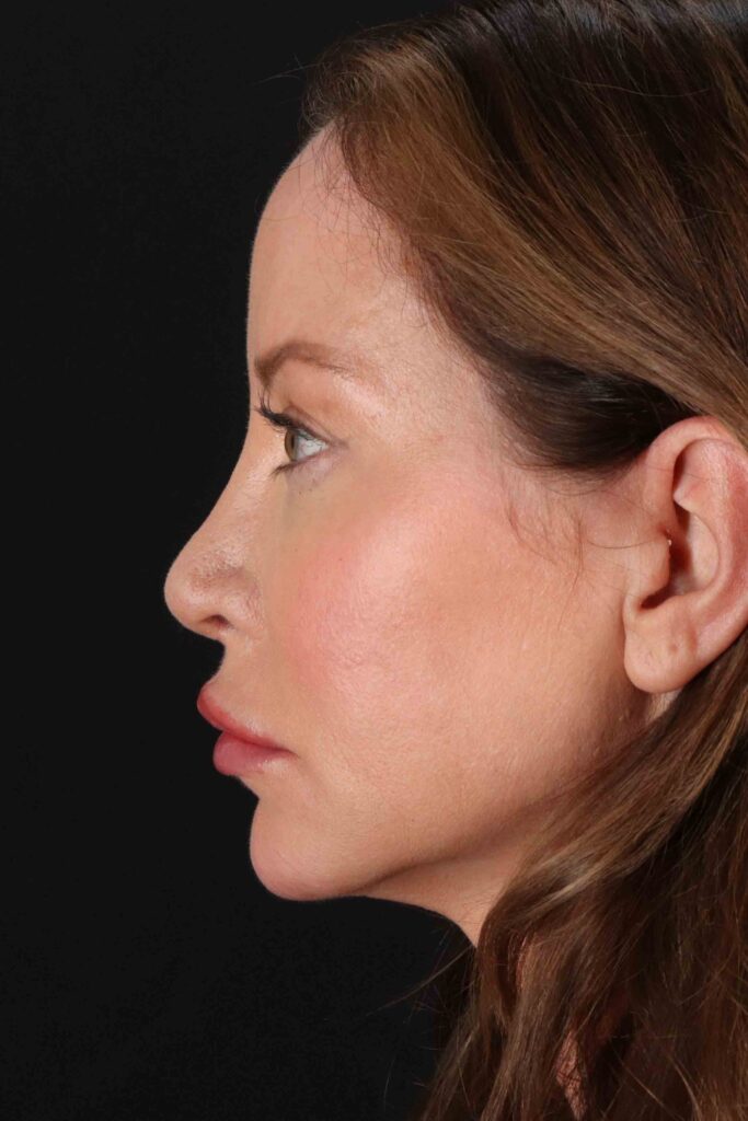 After - left_lateral