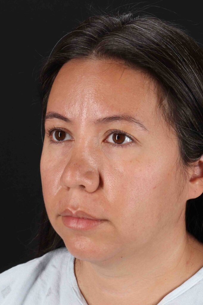 Before - left_oblique