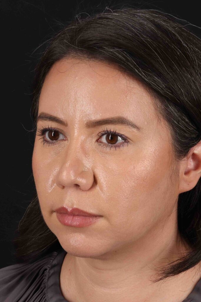 After - left_oblique