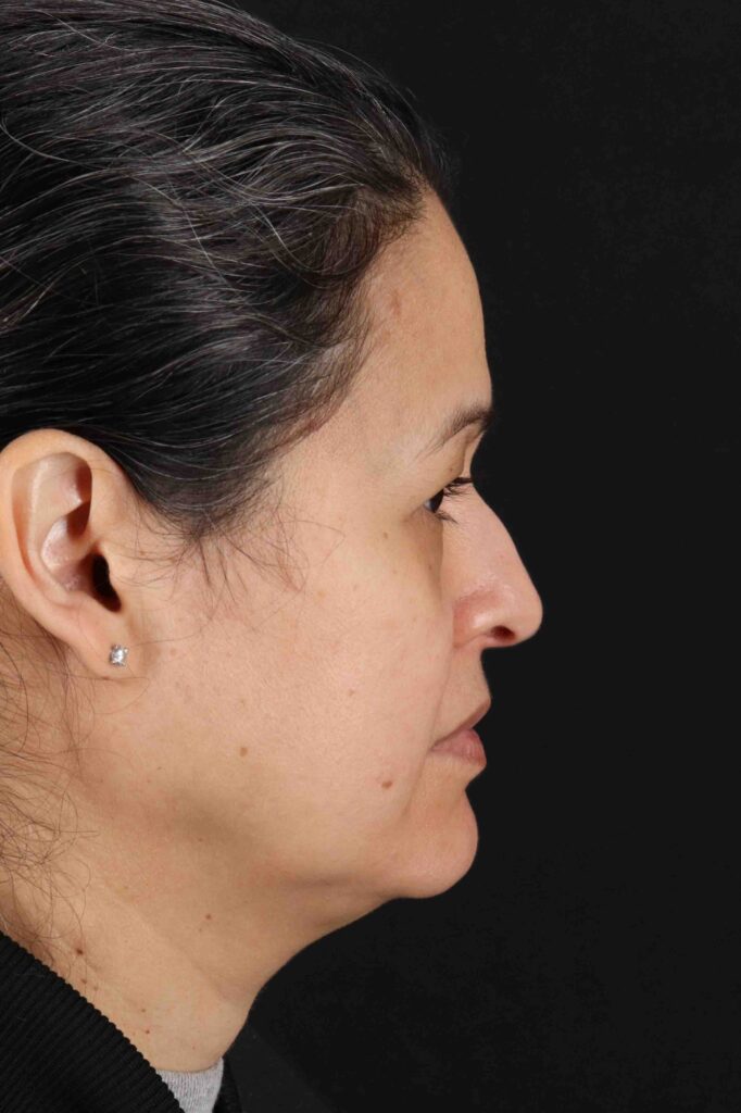 Before - right_lateral