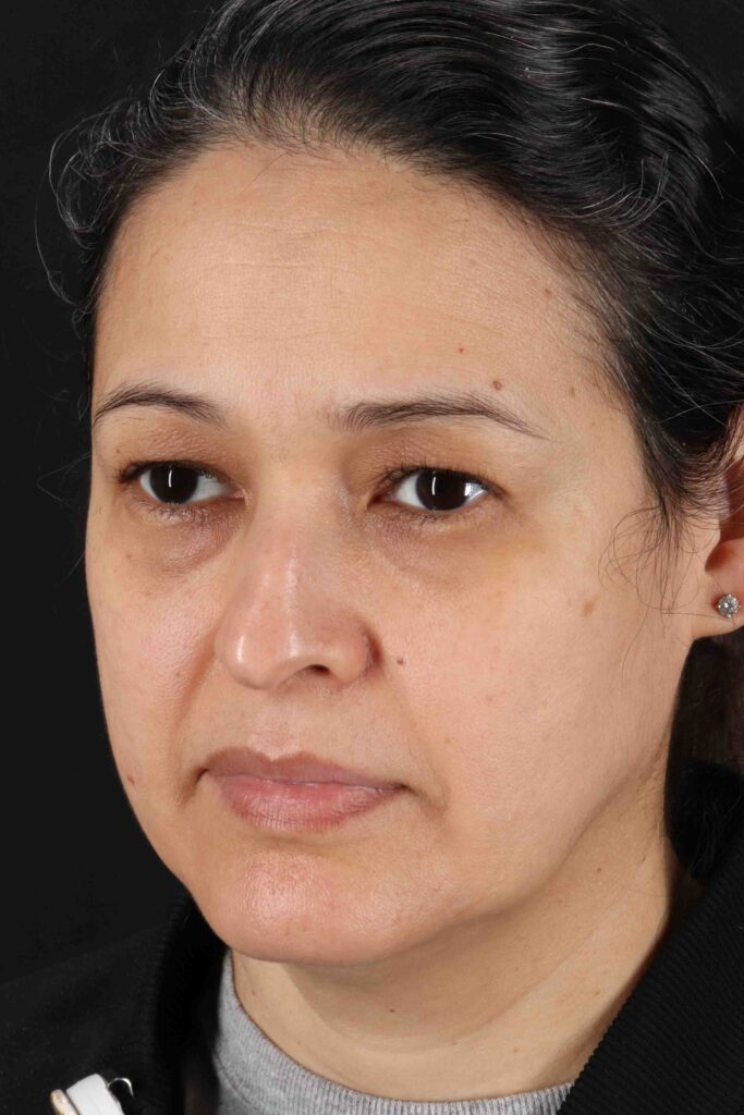 Before - left_oblique