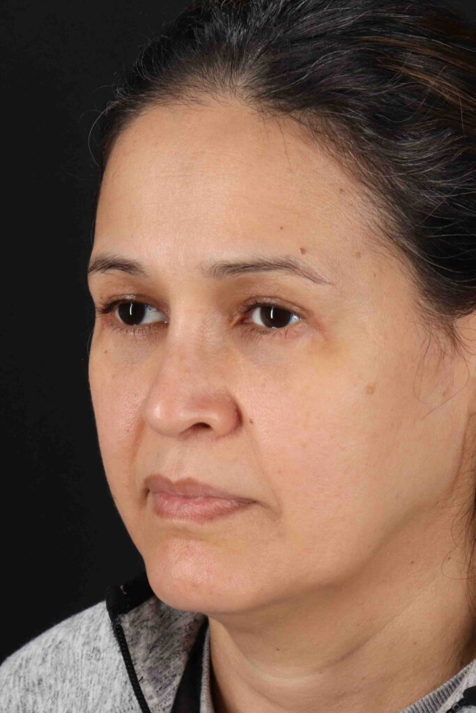 After - left_oblique