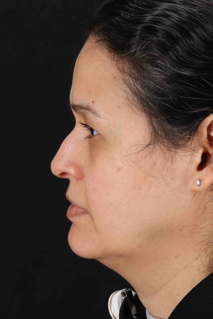 Before - left_lateral