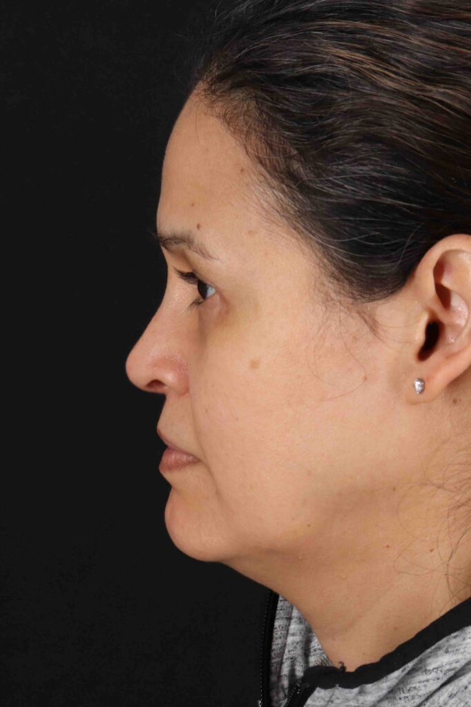 After - left_lateral