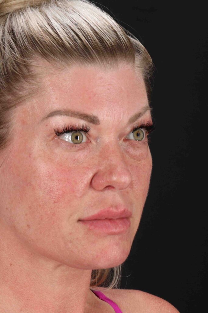 Before - right_oblique