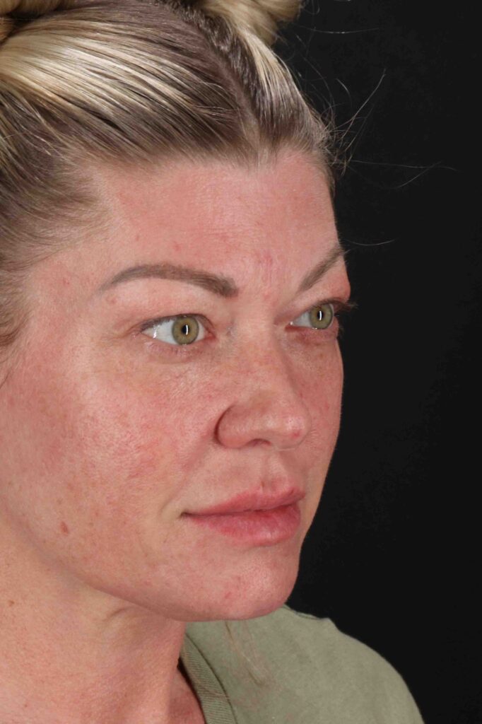 After - right_oblique