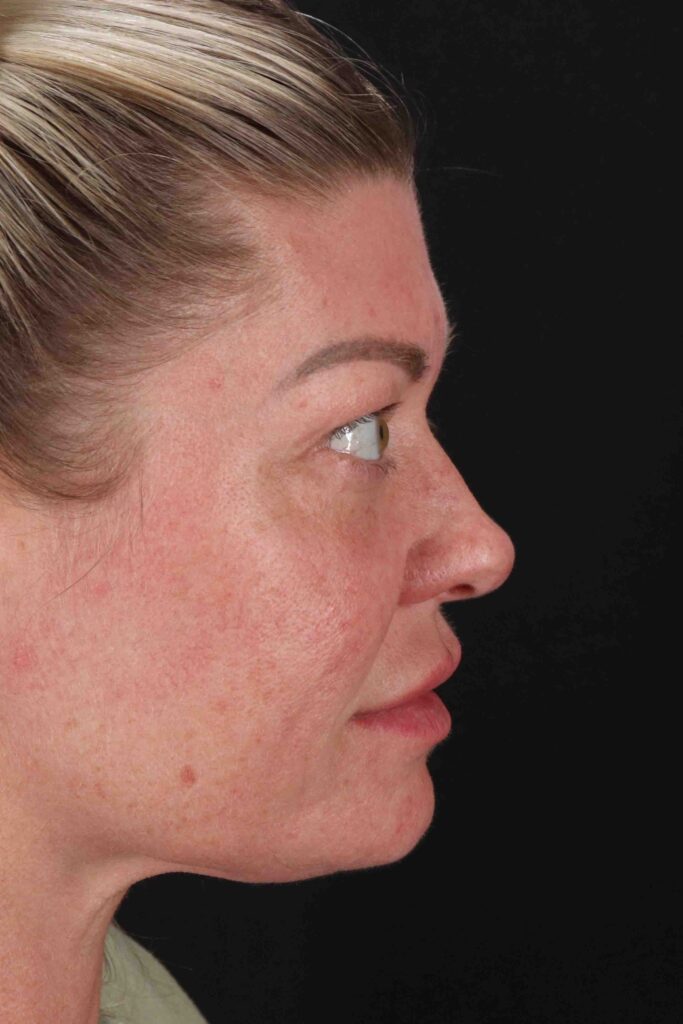 After - right_lateral