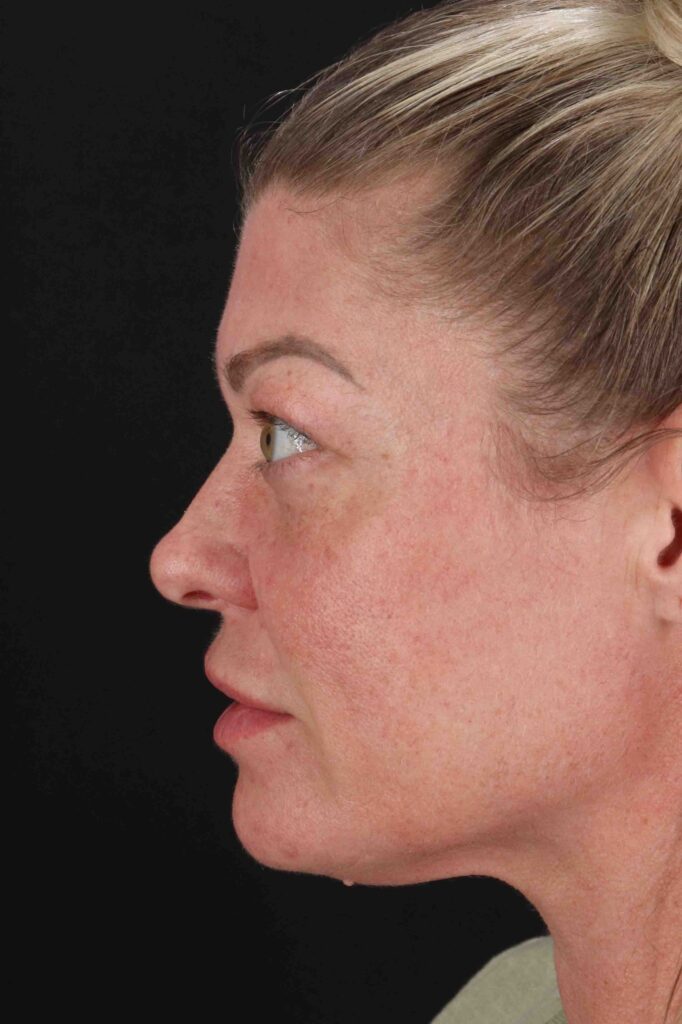 After - left_lateral