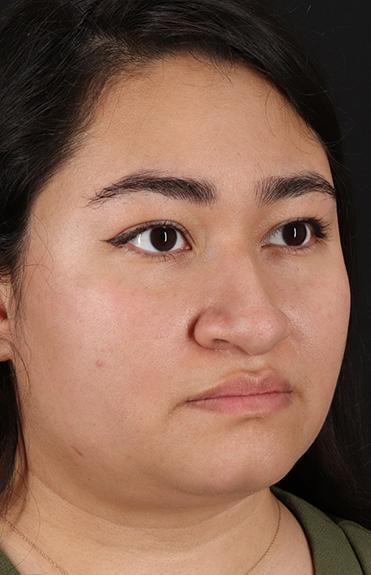 Before - right_oblique