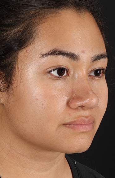 After - right_oblique