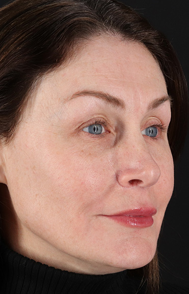 After - right_oblique