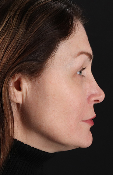 After - right_lateral