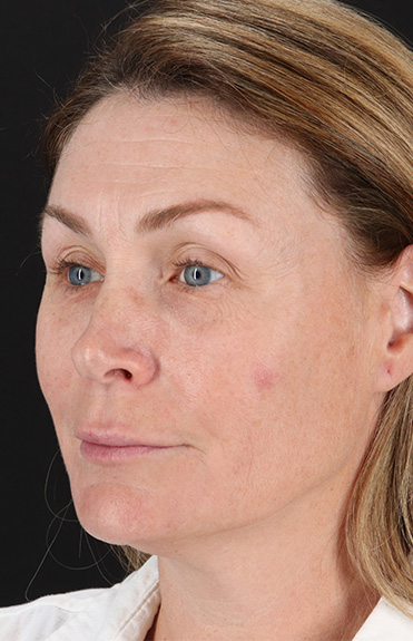 Before - left_oblique