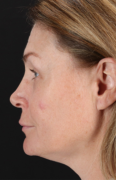 Before - left_lateral