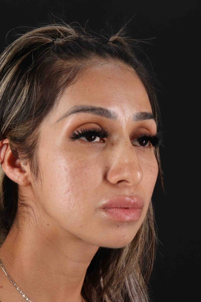 Before - right_oblique