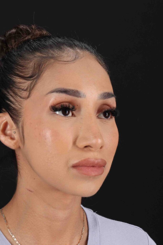 After - right_oblique