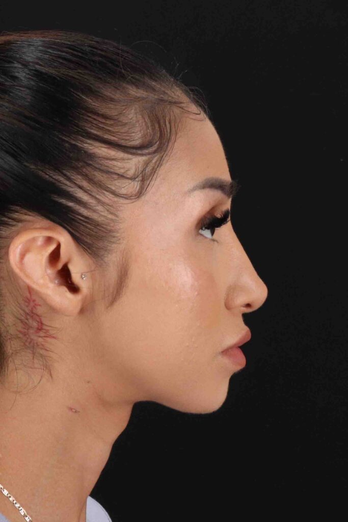 After - right_lateral