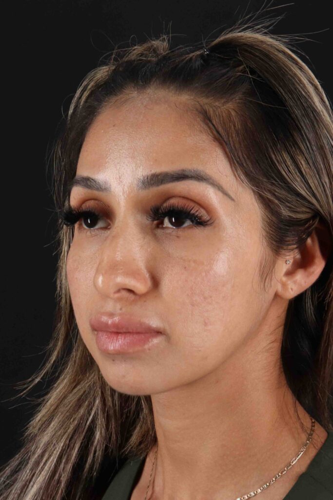 Before - left_oblique