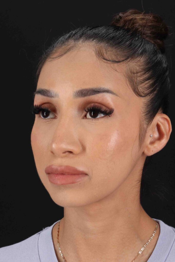 After - left_oblique