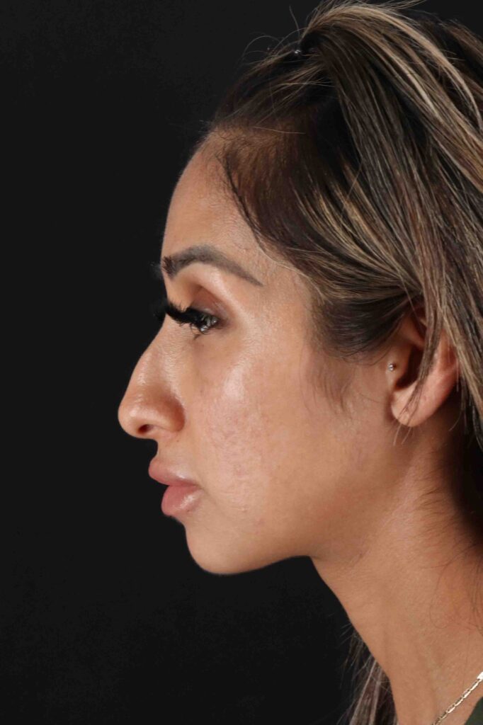 Before - left_lateral