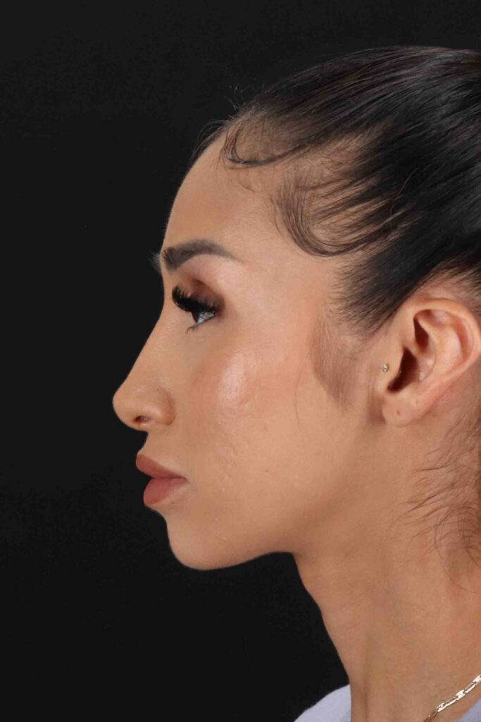 After - left_lateral