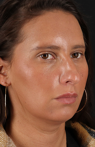 Before - right_oblique