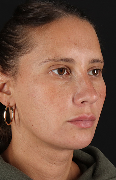 After - right_oblique