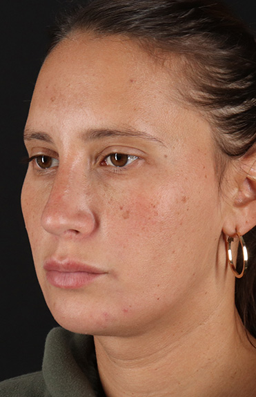 After - left_oblique