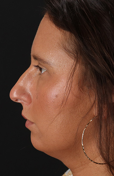 Before - left_lateral