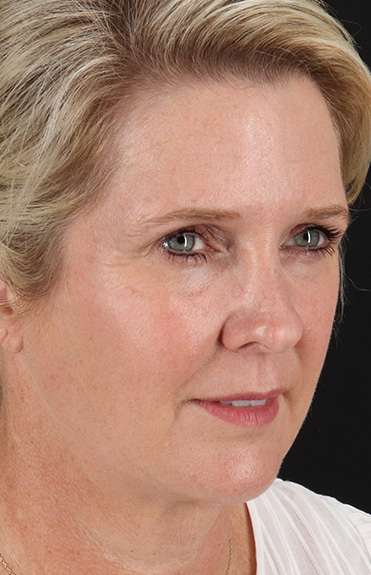 Before - right_oblique