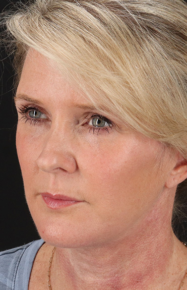 After - left_oblique