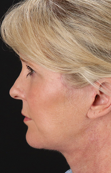 After - left_lateral