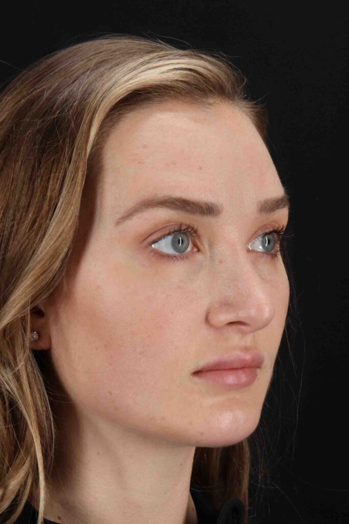 Before - right_oblique