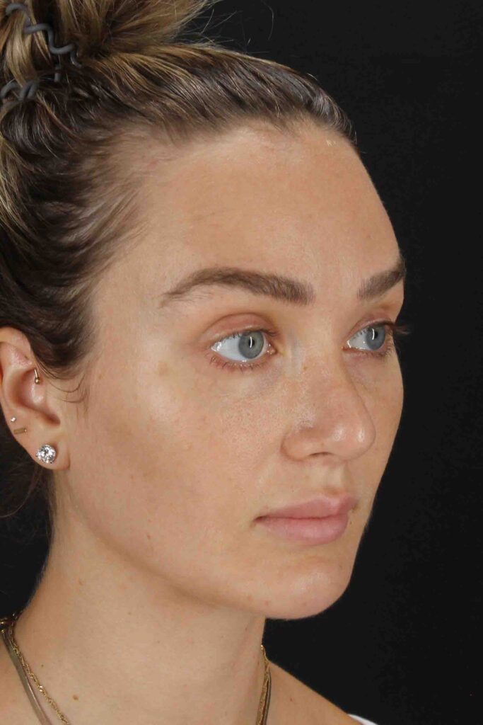 After - right_oblique